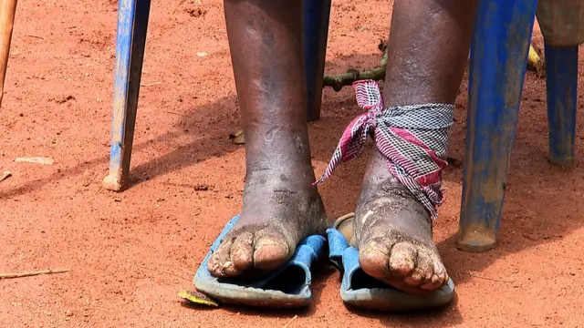 Jambes et pieds poussiéreux avec des plaies visibles, une cheville entourée d’un tissu rouge assis sur un sol terreux rouge